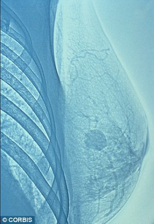 Có thẻ phat hien ung thu vu 9 nam truoc khi phat bẹnh-Hinh-2