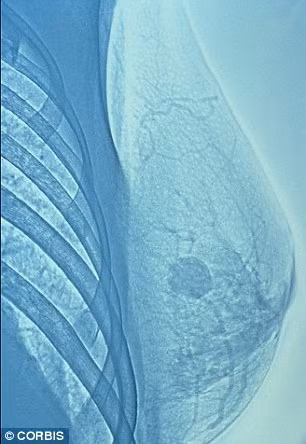 Có thẻ phat hien ung thu vu 9 nam truoc khi phat bẹnh-Hinh-2