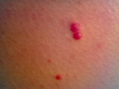 Do thường xuất hiện ở những vùng da hở như cổ, đầu, mặt... nên bạn cần bịt kín để tránh da tiếp xúc với nắng quá lâu. Tại Mỹ, Cơ quan quản lý thuốc và thực phẩm Hoa Kỳ (FDA) đã cho phép sử dụng thuốc Erivedge (vismodegib) để điều trị cho bệnh nhân trưởng thành bị ung thư biểu mô tế bào đáy, hoặc có thể sử dụng phương pháp phẫu thuật Mohs để điều trị cho bệnh nhân dạng này.