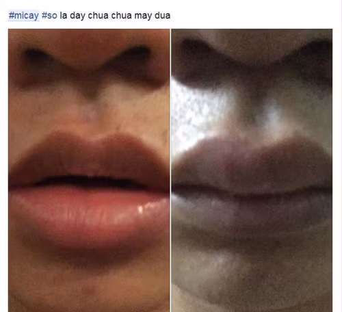 Câu chuyện cô gái ngất xỉu sau khi ăn mỳ quá cay, chàng trai bị sưng vều môi cũng vì món ăn Hàn Quốc này vẫn chưa hạ nhiệt trên cộng đồng mạng thì sự xuất hiện của thánh mỳ cay Anh Phong đã lại làm dân tình bị sốc hơn. Rất nhiều quán ăn đã khuyến cáo các bạn trẻ không nên cố ăn quá cay nếu không quen và thể chất không cho phép. Những trường hợp cố gắng ăn mỳ siêu cay để chứng tỏ bản thân chắc chắn cũng phải chịu một số ảnh hưởng về sức khỏe, các dấu hiệu bất thường ở miệng, môi và đặc biệt là trong dạ dày.