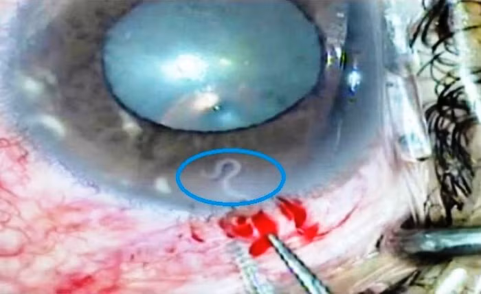 Con giun Toxocara (hay còn gọi là giun đũa chó) ký sinh trong mắt của chị V.T.P ở Nghệ An