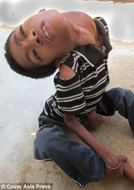 Xương cột sống của Ahirwar quá yếu để nâng đầu thẳng. Việc này đồng nghĩa cậu không thể đứng hay đi lại, mà chỉ có thể ngồi và di chuyển rất khó khăn. Thậm chí, việc ăn uống, sinh hoạt cá nhân mỗi ngày, Ahirwar đều cần ai đó trong gia đình trợ giúp.