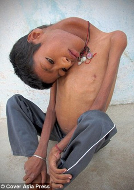 Được biết, Mahendra Ahirwar mắc bệnh rối loạn cơ bắp hiếm gặp khiến phần cơ cổ yếu không thể giữ được đầu ở tư thể thẳng như người bình thường.