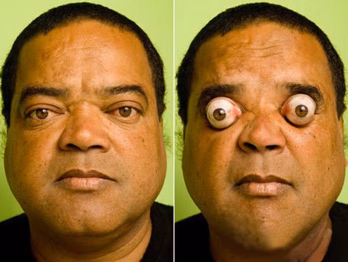 Claudio Pinto sống tại Brazil được phát hiện như người đặc biệt đầu tiên trên thế giới có khả năng điều khiển đôi mắt lồi ra bên ngoài tới hơn 4cm.