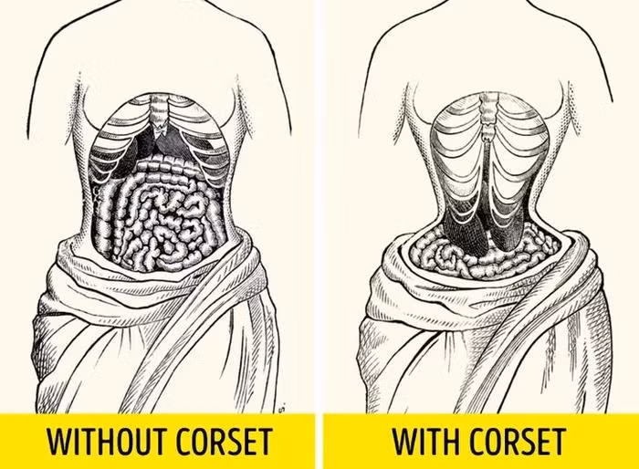 4. Corset (áo nịt) chặt đến nỗi thay đổi vị trí nội tạng của phụ nữ: Áo nịt ngực của họ chặt đến nỗi gây ra teo cơ, thay đổi hình dạng của xương ngực và thay đổi vị trí nội tạng. Vị trí nội tạng của phụ nữ thế kỷ 19 không giống với người phụ nữ hiện đại.