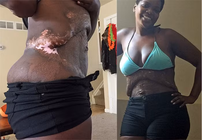 Phương pháp này chỉ dùng cho những người béo phì nặng, phải có giám sát của bác sĩ chuyên khoa. Nếu không cẩn thận có thể gây ra việc tắc mạch máu và nhiễm trùng sau phẫu thuật. Tắc mạch có thể dẫn đến tử vong và nhiễm trùng cũng gây nguy hiểm không kém. Ảnh: Thesun.