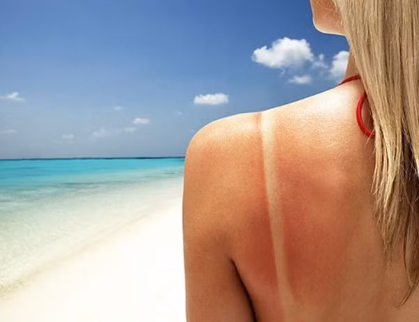 Chữa làn da cháy nắng. Hãy hòa tan 2 thìa cafe muối trắng trong 1 ly nước và vỗ nhẹ vào vùng da này. Da của bạn sẽ nhanh chóng giảm đỏ và trở nên mát lành. Ảnh: Tinmoi.