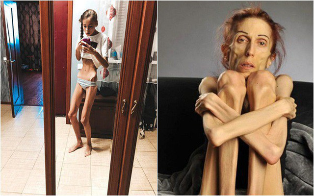 Luôn theo đuổi sự hoàn hảo nên Daria và Maria quyết tâm giảm cân để trở nên xinh đẹp hơn nữa. Họ sẵn sàng nhịn ăn và ép cân thật nhanh, rồi dần dần mắc chứng biếng ăn từ lúc nào không hay, cơ thể thì xanh xao, gầy gò, yếu ớt.