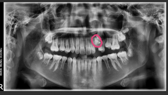 Be 12 tuoi bi u rang: Trieu chung, dieu tri, dinh duong phu hop?