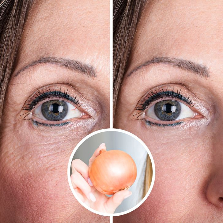 Chống lão hoá, bảo vệ da: Hành tây chứa nhiều vitamin A, C và E giúp bạn luôn có làn da sáng mịn và ngăn ngừa mụn trứng cá. Đặc biệt hơn, bôi gel chiết xuất từ hành tây lên vết sẹo cũng sẽ có tác dụng làm mờ sẹo. Ảnh: BS.