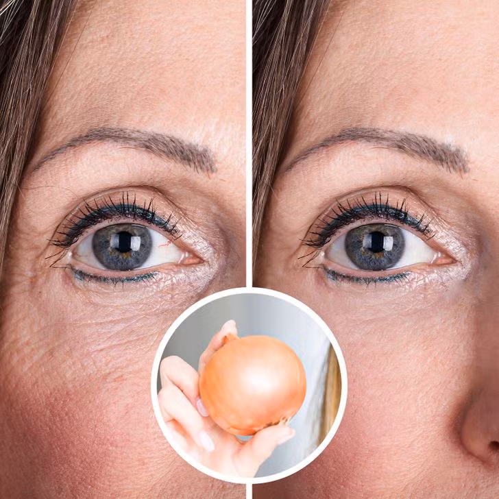 Chống lão hoá, bảo vệ da: Hành tây chứa nhiều vitamin A, C và E giúp bạn luôn có làn da sáng mịn và ngăn ngừa mụn trứng cá. Đặc biệt hơn, bôi gel chiết xuất từ hành tây lên vết sẹo cũng sẽ có tác dụng làm mờ sẹo. Ảnh: BS.