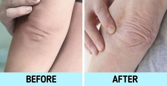 Khuỷu tay: Khi bạn già đi, vùng da quanh khuỷu tay trở nên nhăn nheo và chùng nhão. Việc ma sát liên tục với quần áo hoặc bàn làm việc khiến da vùng này khô và có nhiều nếp nhăn. Để giảm thiểu các dấu hiệu lão hóa, bạn nên tẩy tế bào chết thường xuyên và thoa kem dưỡng ẩm.