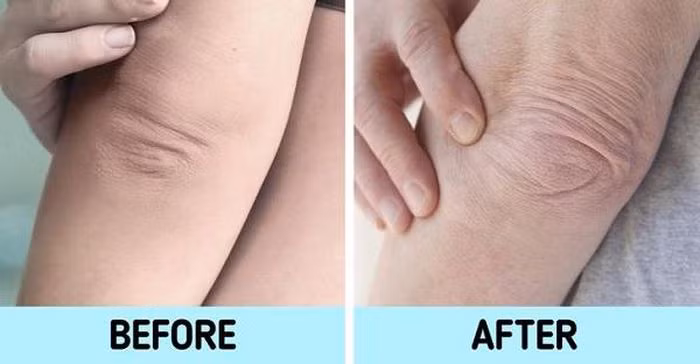 Khuỷu tay: Khi bạn già đi, vùng da quanh khuỷu tay trở nên nhăn nheo và chùng nhão. Việc ma sát liên tục với quần áo hoặc bàn làm việc khiến da vùng này khô và có nhiều nếp nhăn. Để giảm thiểu các dấu hiệu lão hóa, bạn nên tẩy tế bào chết thường xuyên và thoa kem dưỡng ẩm.