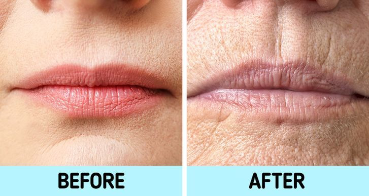 Môi: Tương tự như vùng da quanh mắt, môi mỏng manh hơn rất nhiều so với các bộ phận khác trên cơ thể. Một số thói quen như hút thuốc hoặc mím môi có thể góp phần hình thành nếp nhăn sớm quanh môi. Môi mất nước cũng dễ bị nứt nẻ hơn và đôi khi có thể mất màu tự nhiên.