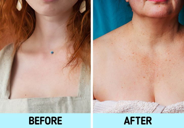 Ngực: Các đốm tàn nhang trên vùng da ngực sẽ trở nên lớn hơn và sẫm màu hơn theo thời gian. Ngoài ra, một dấu hiệu tuổi tác khác biểu hiện ở vùng da ngực là tình trạng mẩn đỏ và giãn nở mạc máu do tác hại của tia UV.