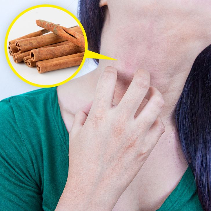 4. Quế trị mụn: Quế là một giải pháp chống mụn trứng cá phổ biến. Tuy nhiên, nhiều người đã thêm thành phần này vào mặt nạ, một số người đã bị dị ứng và cảm giác nóng rát. Việc sử dụng quế có thể dẫn đến mẩn đỏ, phát ban và kích ứng.