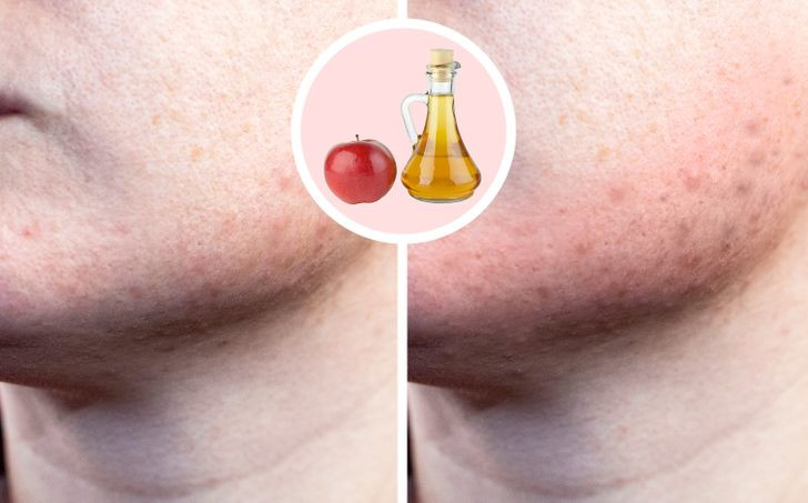 2. Giấm táo trị mụn: Nhiều người sử dụng giấm táo điều trị mụn trứng cá, gàu, hoặc thậm chí như một chất khử mùi tự nhiên. Tuy nhiên, tính axit cao của giấm táo có thể dẫn đến bỏng hóa chất nguy hiểm trên da. Để sử dụng tốt hơn, hãy thử thêm nước vào hỗn hợp.