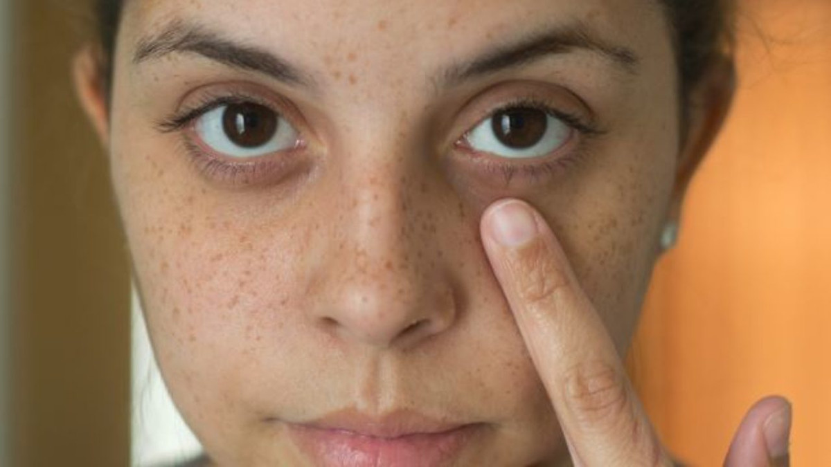 Lý do gây ra quầng thâm mắt ở mỗi người là khác nhau, nhưng một nguyên nhân chính là do các mạch máu bị thiếu oxy lưu thông tự do gây tăng sắc tố. Tăng sắc tố da được tạo ra bởi một axit amin gọi là melanin. Ngoài ra, quầng thâm cũng có thể do các bệnh lý như dị ứng, chàm, viêm da và thiếu máu gây ra.