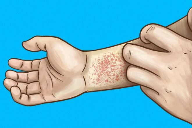 Da khô, ngứa: Thận khoẻ mạnh sẽ loại bỏ chất thải và độc tố ra khỏi cơ thể, giúp sản xuất tế bào hồng cầu, duy trì lượng khoáng chất thích hợp. Da khô và ngứa là dấu hiệu cảnh báo thận đang có vấn đề, không duy trì được sự cân bằng khoáng chất và dinh dưỡng phù hợp.