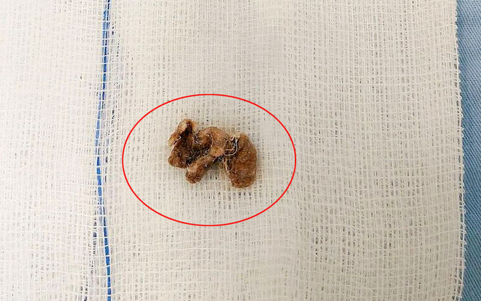 Be gai nhet di vat trong “vung kin”: Day tre tranh tai pham