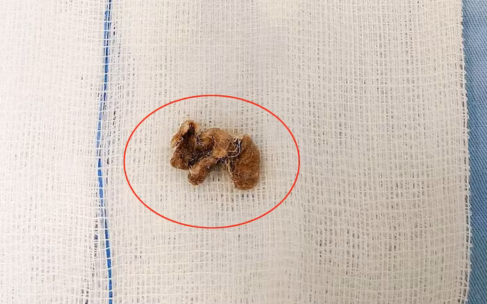 Be gai nhet di vat trong “vung kin”: Day tre tranh tai pham