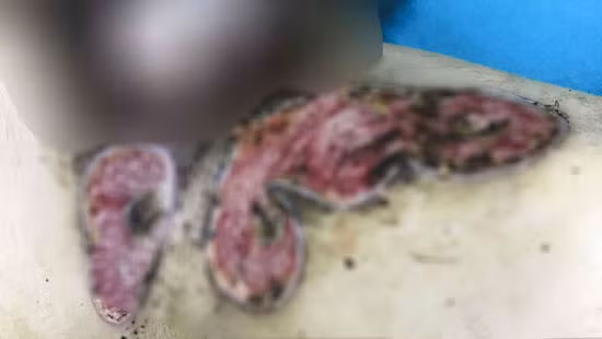 Hoại tử chân vì thuốc chữa bỏng: Loạt ca cấp cứu vì “lang băm” - Hình 4 Hoai tu chan vi thuoc chua bong: Loat ca cap cuu vi “lang bam”-Hinh-4