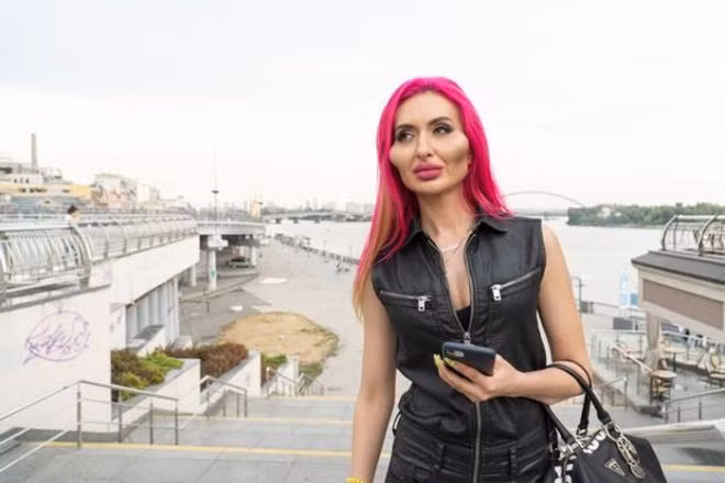 Nguoi mau co cap ma loi lom kinh di vi nghien tiem filler-Hinh-2