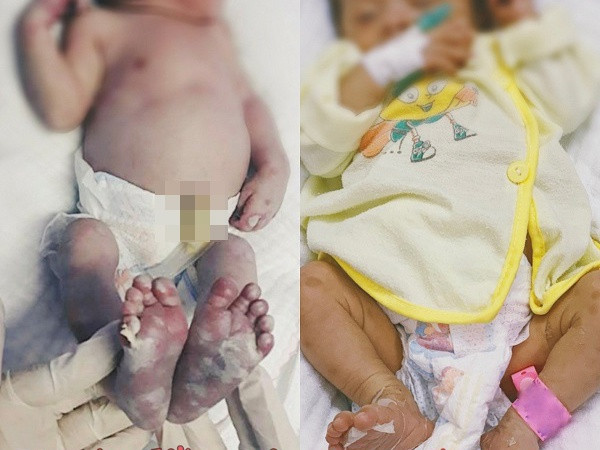 Be so sinh o Nghe An mac benh giang mai