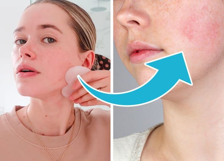 Đá gua sha massage làm mịn da: Massage da bằng đá gua sha giúp cải thiện lưu thông máu, giảm đau cổ, vai nhưng việc chà xát quá mạnh có thể khiến các mạch máu nhỏ gần bề mặt da bị vỡ, dẫn đến bầm tím và chảy máu dưới da.