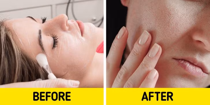 Tẩy da chết hoá học: Nếu bạn đang sử dụng sản phẩm tẩy da chết hoá học nhiều hơn một lần mỗi tuần thì nên kiểm tra lại tình trạng da. Lạm dụng sản phẩm này có thể làm hỏng lớp màng bảo vệ tự nhiên của da, dễ gây viêm, nổi mụn hay khiến da mẩn đỏ, kích ứng.