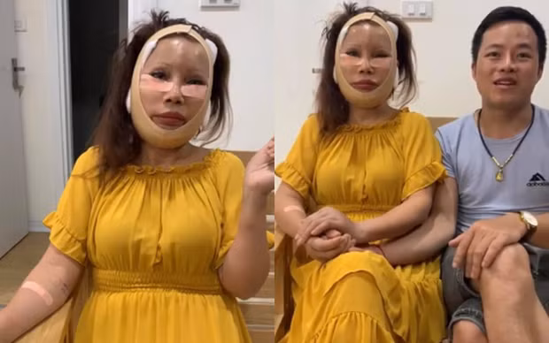 Trước đó, chị Thu Sao đã tiến hành nhấn mí, hút mỡ, bơm mỡ tự thân, hút mỡ cấy mu bàn tay và làm răng sứ.