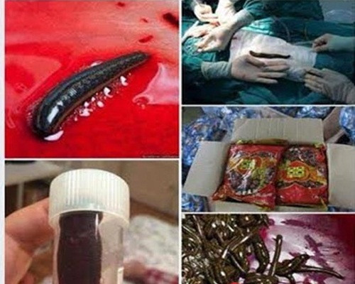 Hình ảnh đỉa lúc nhúc đáng sợ.