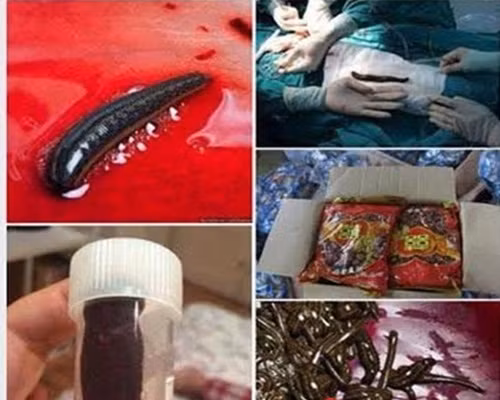 Hình ảnh đỉa lúc nhúc đáng sợ.