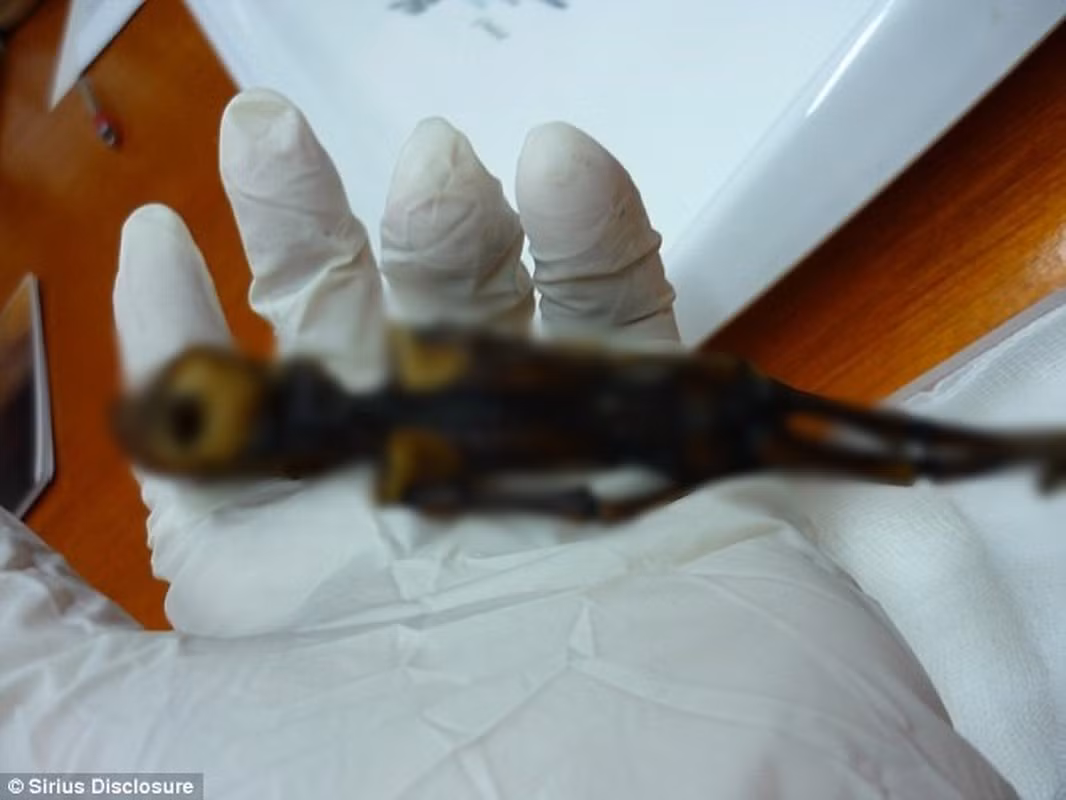 Garry Nolan, giáo sư vi sinh vật học và miễn dịch học ở Trường y thuộc Đại học Stanford, California, cho hay nhóm nghiên cứu xác định được 4 biến thể nucleotide đơn mới (SNV) - một dạng đột biến gene, ở những gene gây ra các bệnh về xương như chứng vẹo cột sống hoặc trật khớp cùng 2 SNV ở các gene liên quan đến sản sinh collagen.