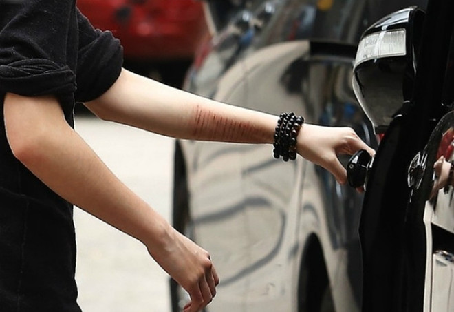 Cánh tay chi chít những vết rạch của Ngô Trác Lâm.