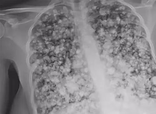 Nghien thuoc la dien tu, phoi nam sinh 17 tuoi bien thanh “bong ngo”-Hinh-2