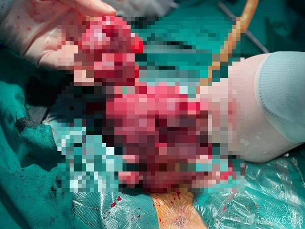 Tri hoan viec nay, benh nhan 42 tuoi tu cung “moc” u chi chit nhu sung