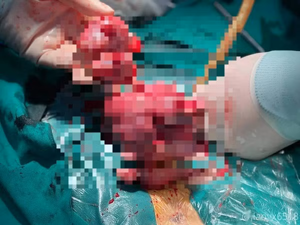 Tri hoan viec nay, benh nhan 42 tuoi tu cung “moc” u chi chit nhu sung