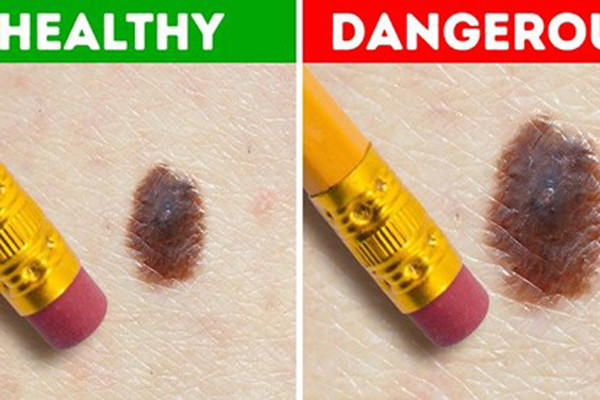 Thay đổi hình dáng, kích thước nốt ruồi ở chân. Nốt ruồi là sản phẩm của sắc tố tích tụ dưới da. Khi sức khỏe bình thường, nốt ruồi sẽ không có thay đổi rõ ràng.