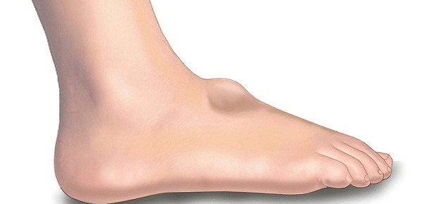 Chuyên gia nhấn mạnh, nếu da chân mịn màng bỗng dưng xuất hiện u cục, bạn nên chú ý ung thư phổi, ung thư buồng trứng, ung thư cổ tử cung hoặc ung thư xương di căn. Ảnh: Internet.