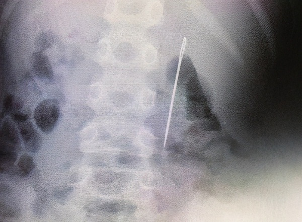 Giau me mot viec, be 8 tuoi suyt thung ruot, phai phau thuat gap