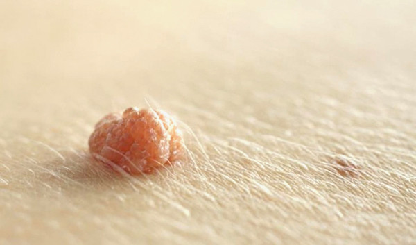 Một số trường hợp, mụn thịt có thể tự rụng mà không cần can thiệp. Mụn thịt tự biến mất sau khi mụn xoắn lại ở phần thân, làm gián đoạn lưu lượng máu đến chúng.