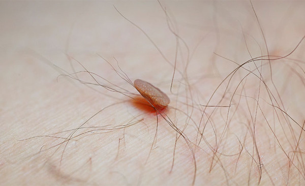 Khi mụn thịt dư có bề mặt màu đỏ, cảm giác hơi đau, xuất hiện nhân nhỏ bên trong bạn nên cảnh giác. Nhất là trong điều kiện môi trường nắng nóng, các lỗ chân lông không được đào thải độc tố gây bít tắc.