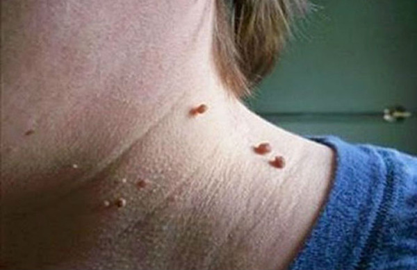 Mụn thịt dư có thể xuất hiện ở nhiều vị trí trên cơ thể song phổ biến nhất là vùng cổ, nách. Mụn thịt dư ở cổ thường có màu da hoặc nâu. Nhìn bề ngoài, mụn thịt dư có nét giống như mụn cơm, không mang lại cảm giác khó chịu, ngứa ngáy.