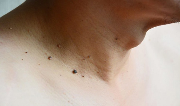 Mụn thịt dư thường xảy ra sau tuổi trung niên. Nguyên nhân trực tiếp gây mụn thịt dư có thể do cơ địa, nội tiết, xuất phát từ bên trong cơ thể người bệnh. Loại mụn này thường do tình trạng tăng sinh collagen khiến cấu trúc da bị thay đổi kết hợp với rối loạn tuyến mồ hôi, da nhạy cảm…