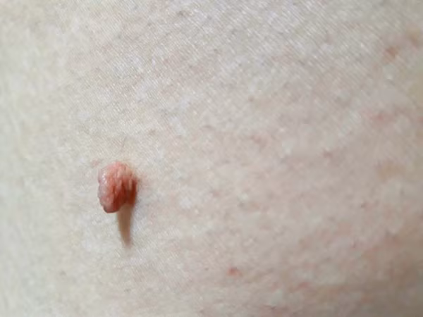 Hầu hết các mụn thịt dư ở cổ đều là lành tính. Dù vậy, bạn không nên chủ quan bỏ qua những bất thường ở chúng.