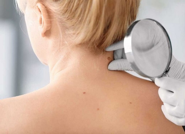 Đa số các trường hợp mụn thịt đều lành tính, chỉ ảnh hưởng ngoại hình. Dù vậy, tuyệt đối không tự ý xử lý mụn thịt bằng cách chích mụn bằng kim vì có thể gây ra sẹo xấu, thậm chí là viêm loét, nhiễm trùng, bội nhiễm,... khiến tình trạng nghiêm trọng hơn.