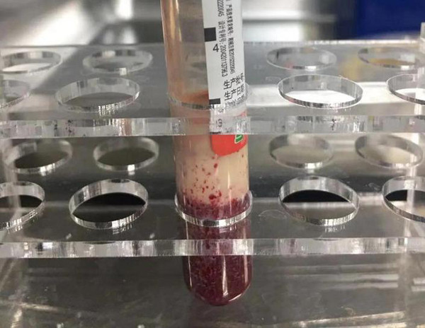 Trường hợp bệnh của A Kiệt không phải duy nhất có vấn đề sức khỏe liên quan đến trà sữa. Cách đây không lâu, một giáo viên sống tại Nhạc Lộc, Hồ Nam, Trung Quốc bỗng dưng cảm thấy đau bụng âm ỉ khi đang đứng lớp. Cứ nghĩ bệnh dạ dày tái phát, cô Kiều dùng thuốc domperidin nhưng các triệu chứng không hề thuyên giảm mà ngày càng nghiêm trọng hơn. Giờ nghỉ trưa, đồng nghiệp phát hiện cô bất tỉnh trên giường, tiểu tiện không tự chủ, gọi thế nào cũng không phản ứng.