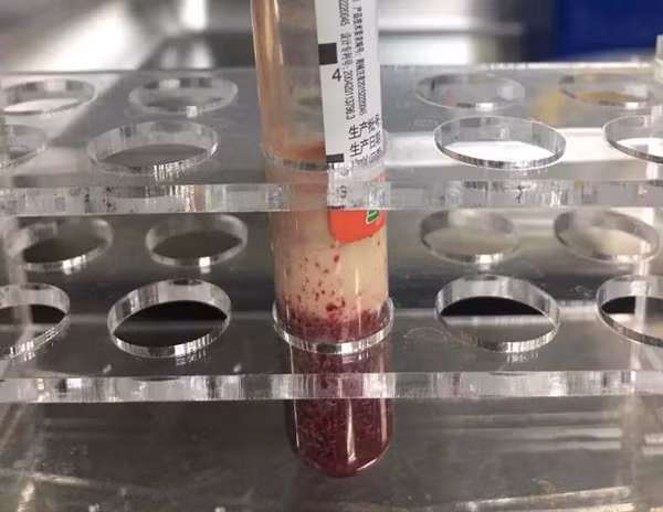 Trường hợp bệnh của A Kiệt không phải duy nhất có vấn đề sức khỏe liên quan đến trà sữa. Cách đây không lâu, một giáo viên sống tại Nhạc Lộc, Hồ Nam, Trung Quốc bỗng dưng cảm thấy đau bụng âm ỉ khi đang đứng lớp. Cứ nghĩ bệnh dạ dày tái phát, cô Kiều dùng thuốc domperidin nhưng các triệu chứng không hề thuyên giảm mà ngày càng nghiêm trọng hơn. Giờ nghỉ trưa, đồng nghiệp phát hiện cô bất tỉnh trên giường, tiểu tiện không tự chủ, gọi thế nào cũng không phản ứng.