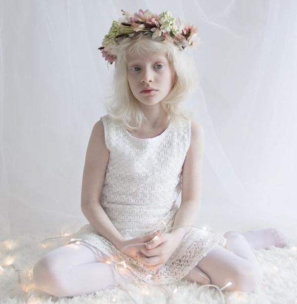 Da của người bị bạch tạng dễ bị bỏng nắng, do đó dễ bị ung thư da. Ngoài ra, bạch tạng còn gây ra rối loạn thị giác, giảm thị lực và sợ ánh sáng. Ảnh: Brightside.